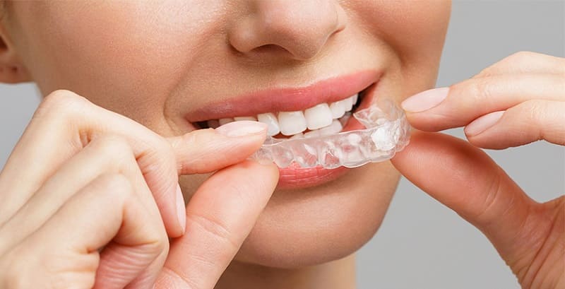 Invisalign Braces